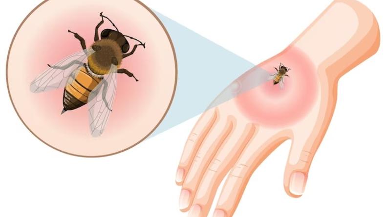 Что делать если укусила пчела или шершень: советы
