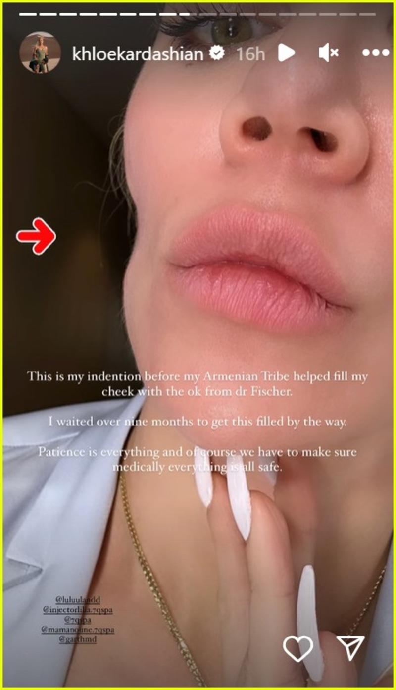 Хлої Кардаш'ян до та після лікування раку шкіри Фото: instagram.com/khloekardashian Хлої Кардаш'ян до та після лікування раку шкіри Фото: instagram.com/khloekardashian