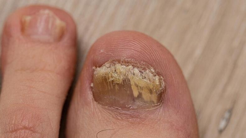 Псориаз ногтей — симптомы, диагностика и методы лечения | Альтермед