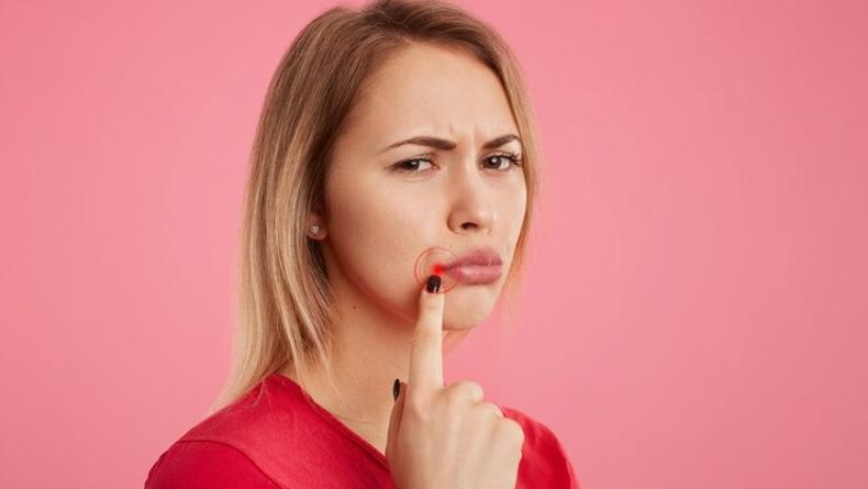 Заеды в уголках губ: почему появляются, как справиться с проблемой